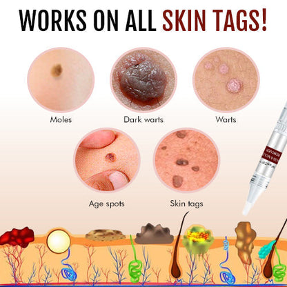 Tags & Moles Remover